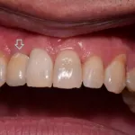 Dental implant case 10 with arrow