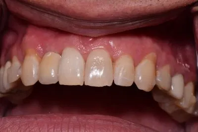 Dental implant case 10