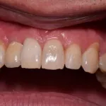Dental implant case 10