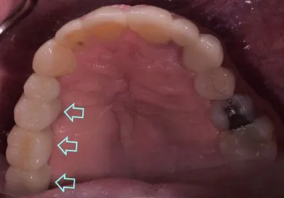 Dental implant case 12 with arrow