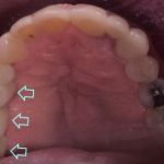 Dental implant case 12 with arrow