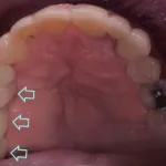 Dental implant case 12 with arrow