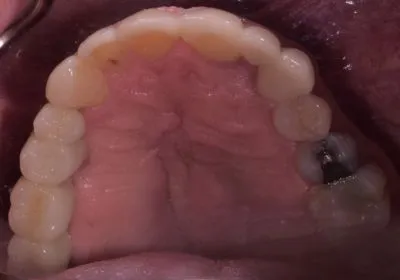 Dental implant case 12