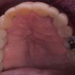 Dental implant case 12
