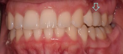 Dental implant case 4 with arrow