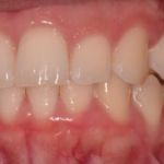 Dental implant case 4 with arrow