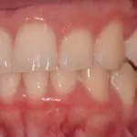 Dental implant case 4 with arrow