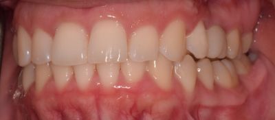 Dental implant case 4