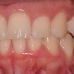 Dental implant case 4