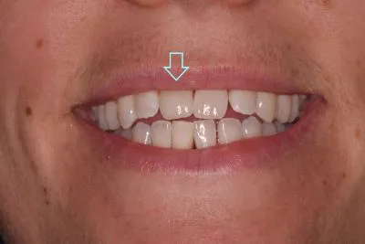 Dental implant case 6 with arrow