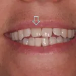 Dental implant case 6 with arrow