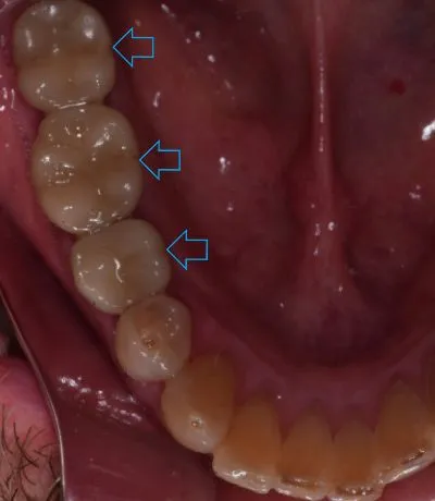 Dental implant case 9 with arrow