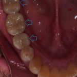 Dental implant case 9 with arrow