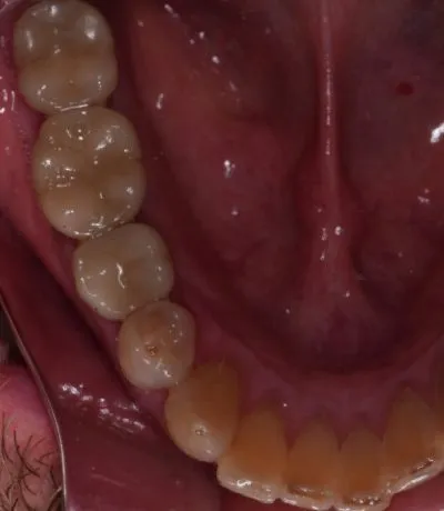 Dental implant case 9