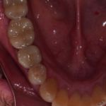 Dental implant case 9