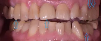 Dental implant case 11 with arrow
