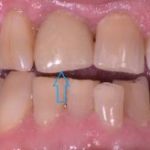 Dental implant case 11 with arrow