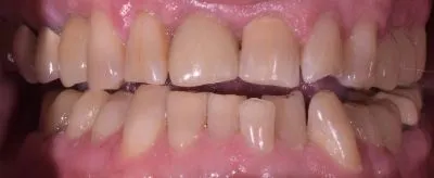 Dental implant case 11