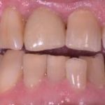 Dental implant case 11