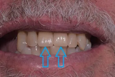 Dental implant case 13 with arrow