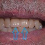 Dental implant case 13 with arrow