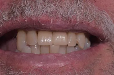 Dental implant case 13
