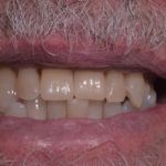 Dental implant case 13