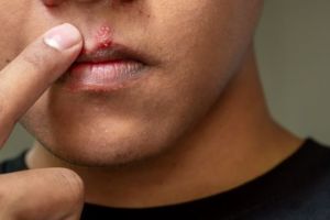 man pointing to cold sore